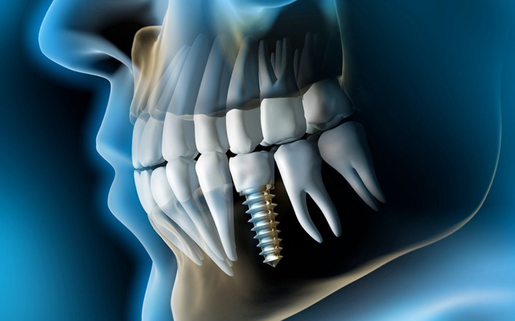Dental Implants, Dental Implants