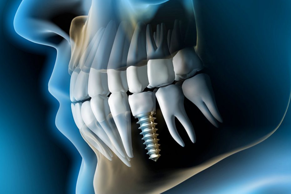 , Dental Implants – A great way to replace missing teeth