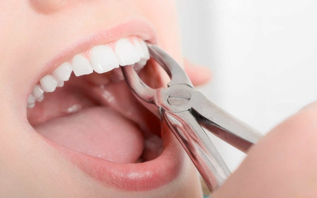Tooth Extractions, Extractions
