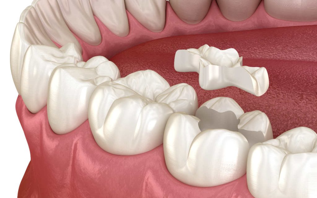 Dental Inlays And Onlays, Inlays and Onlays