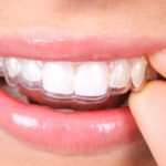 Braces or Invisalign, Braces Or Invisalign: Which Is Better?