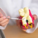 Cavities, How To Prevent Cavities