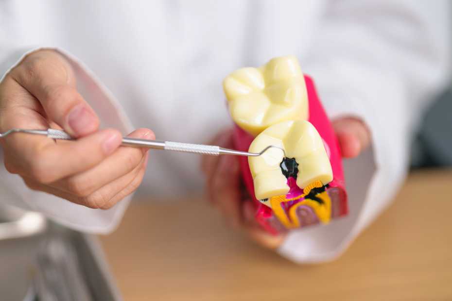 Cavities, How To Prevent Cavities