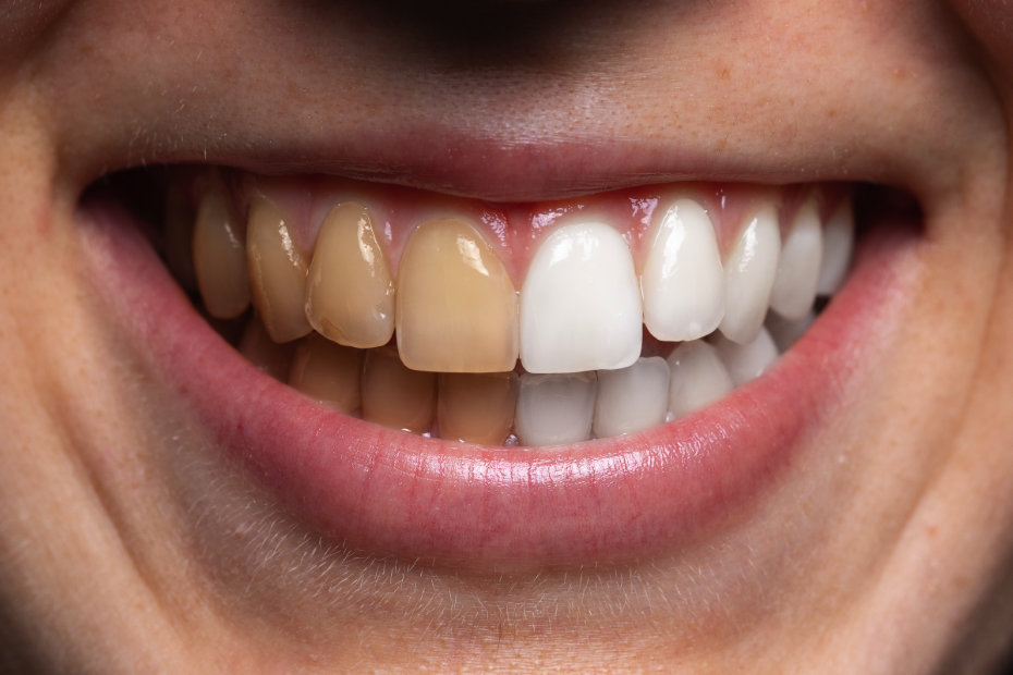 make teeth sparkle - brighter whiter teeth