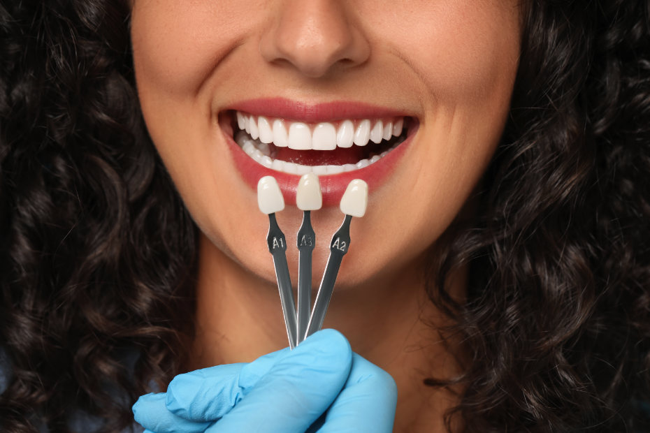 Dental Veneers Benefits Costs Featured